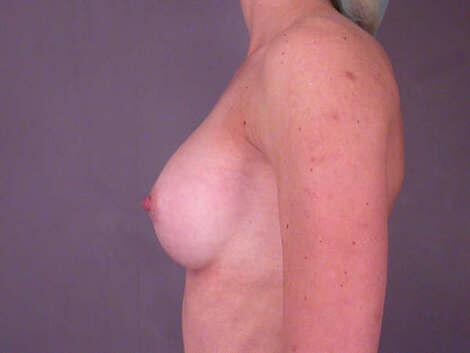 Breast Augmentation Before & After Image