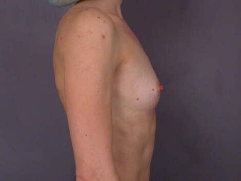 Breast Augmentation Before & After Image