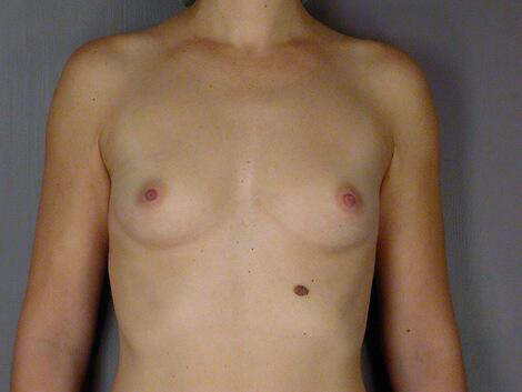 Breast Augmentation Before & After Image