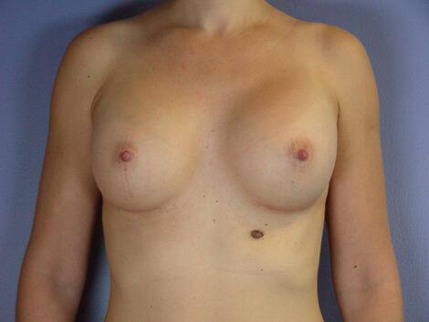 Breast Augmentation Before & After Image