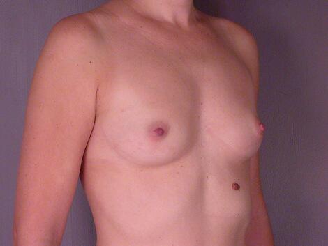 Breast Augmentation Before & After Image