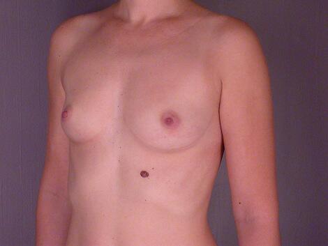 Breast Augmentation Before & After Image