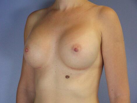 Breast Augmentation Before & After Image