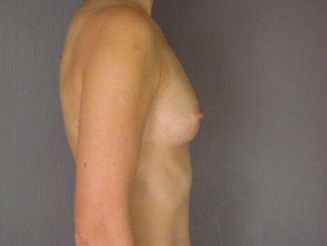 Breast Augmentation Before & After Image