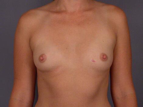 Breast Augmentation Before & After Image