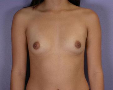 Breast Augmentation Before & After Image