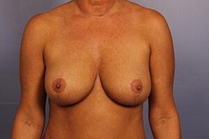 Breast Implant Correction Before & After Image