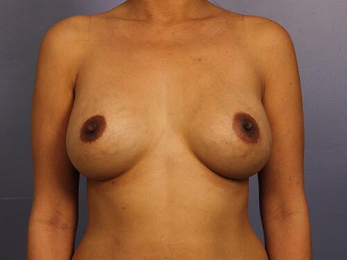 Breast Implant Correction Before & After Image