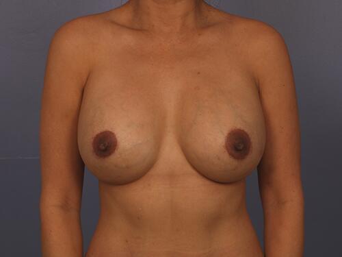 Breast Implant Correction Before & After Image