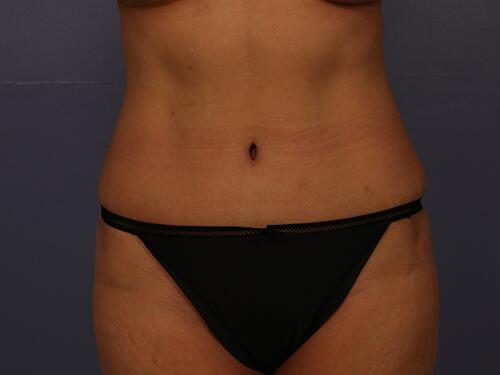 Breast Implant Correction Before & After Image