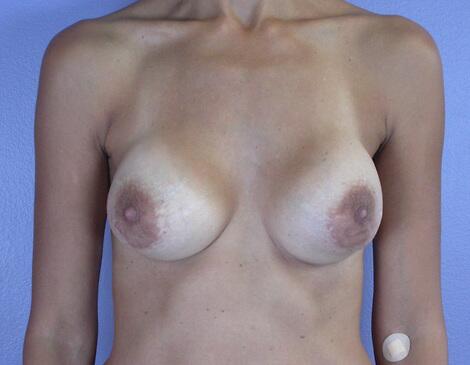 Breast Implant Correction Before & After Image