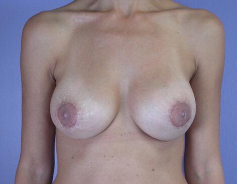 Breast Implant Correction Before & After Image