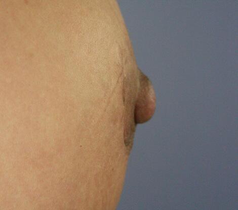 Breast Implant Correction Before & After Image