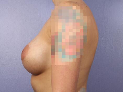 Breast Implant Correction Before & After Image