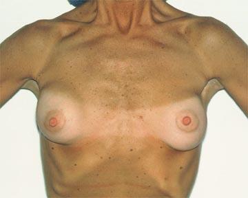 Breast Implant Correction Before & After Image