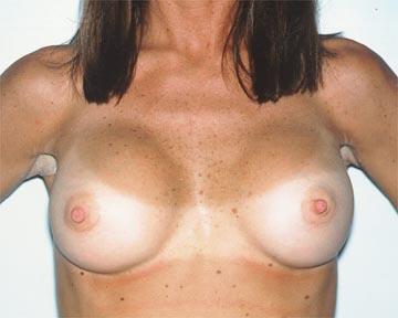 Breast Implant Correction Before & After Image