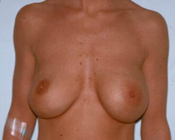 Breast Implant Correction Before & After Image