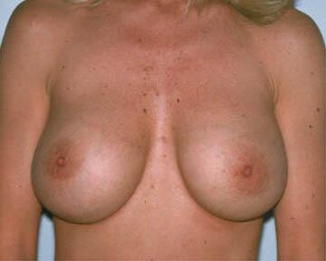 Breast Implant Correction Before & After Image