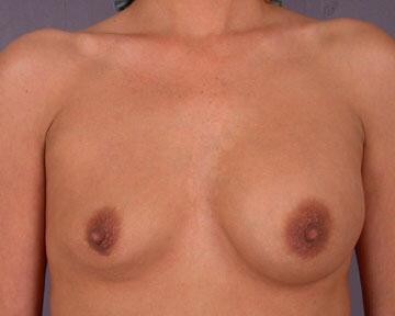 Breast Implant Correction Before & After Image