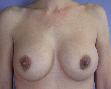 Breast Implant Correction Before & After Image