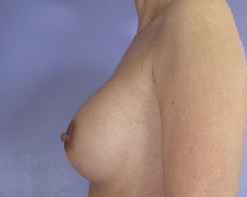 Breast Implant Correction Before & After Image