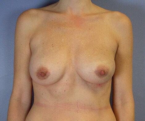 Breast Implant Correction Before & After Image