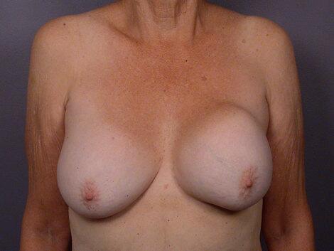 Breast Implant Correction Before & After Image