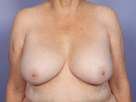 Breast Implant Correction Before & After Image