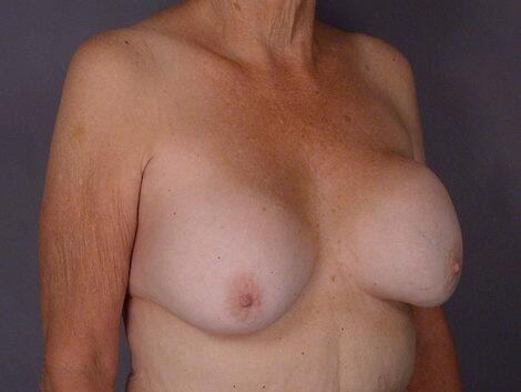 Breast Implant Correction Before & After Image