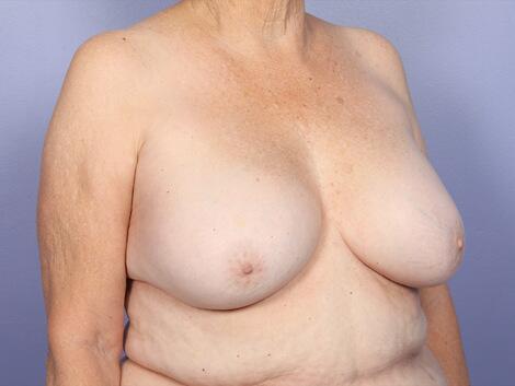 Breast Implant Correction Before & After Image