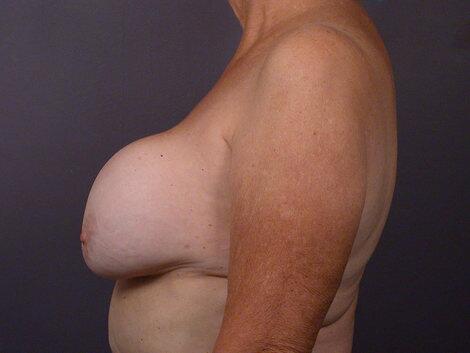 Breast Implant Correction Before & After Image