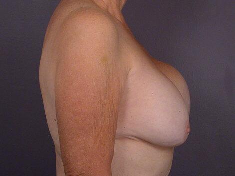 Breast Implant Correction Before & After Image