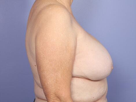 Breast Implant Correction Before & After Image