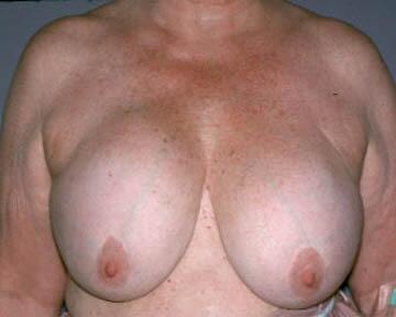 Breast Implant Correction Before & After Image