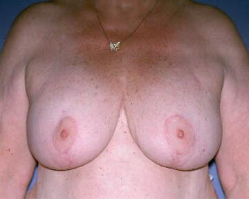 Breast Implant Correction Before & After Image