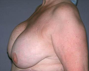 Breast Implant Correction Before & After Image