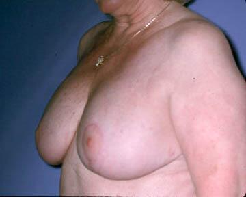 Breast Implant Correction Before & After Image