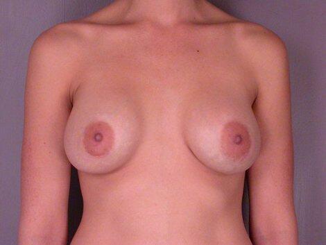 Breast Implant Correction Before & After Image