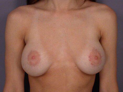 Breast Implant Correction Before & After Image