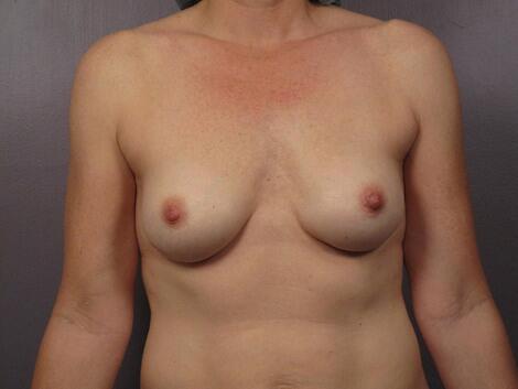 Breast Implant Correction Before & After Image