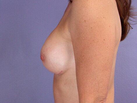 Breast Implant Correction Before & After Image