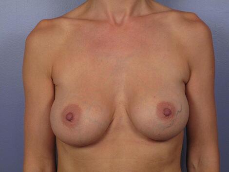 Breast Implant Correction Before & After Image