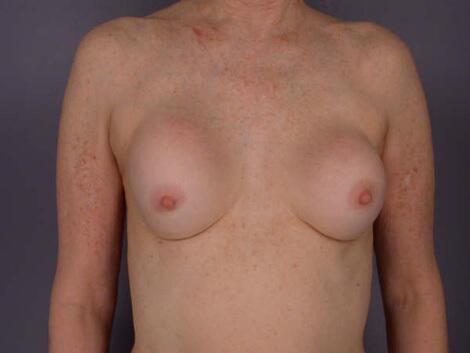 Breast Implant Correction Before & After Image