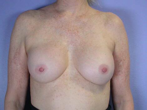 Breast Implant Correction Before & After Image