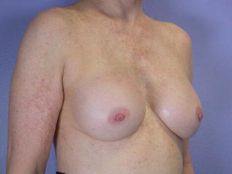 Breast Implant Correction Before & After Image