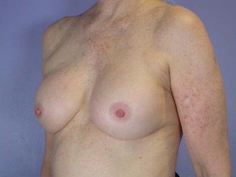 Breast Implant Correction Before & After Image