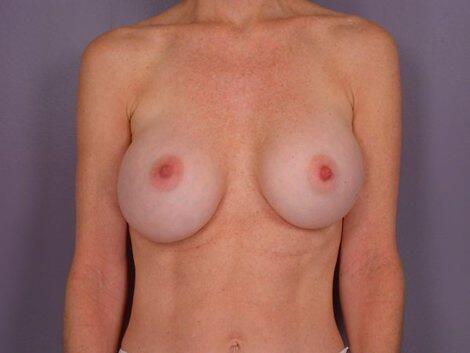 Breast Implant Correction Before & After Image