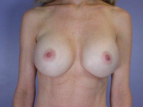 Breast Implant Correction Before & After Image