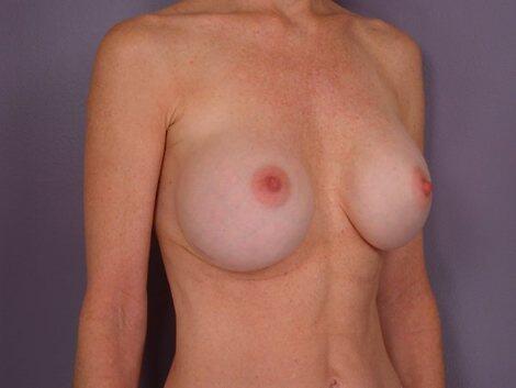 Breast Implant Correction Before & After Image