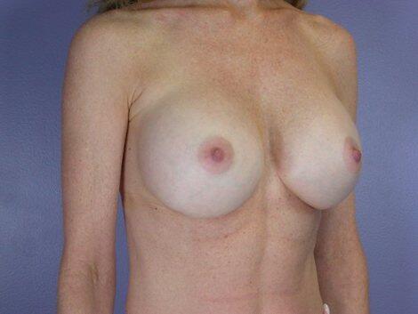 Breast Implant Correction Before & After Image